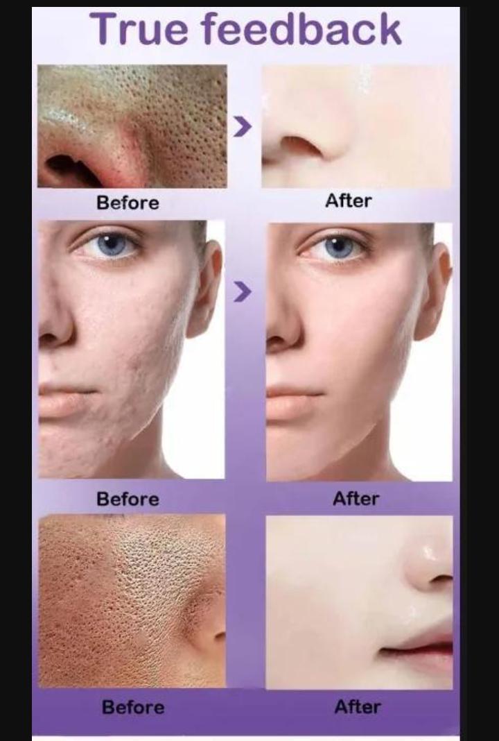 Fort Anti Acne Gel For Acne & Spot Removal With Salicylic Acid & Vitamin C,E | Anti Acne Face Treatment Gel | 50ml