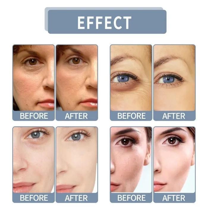 Fort Anti Acne Gel For Acne & Spot Removal With Salicylic Acid & Vitamin C,E | Anti Acne Face Treatment Gel | 50ml